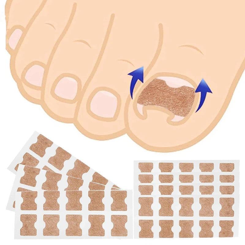Set Corrector de Uñas Encarnadas